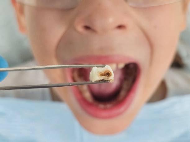 Best Emergency Tooth Extraction in Madison Park, NJ